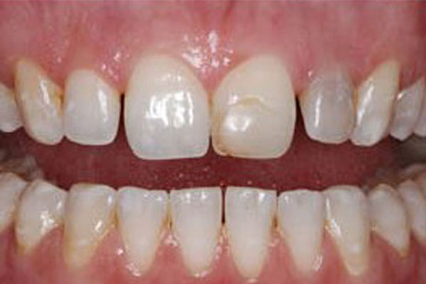 Teeth before cosmetic dentistry in Sharon.