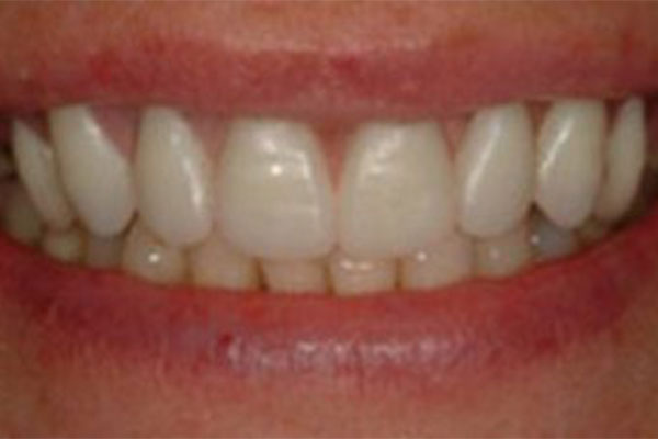 Beautiful, natural-looking smile after dentures in Sharon.