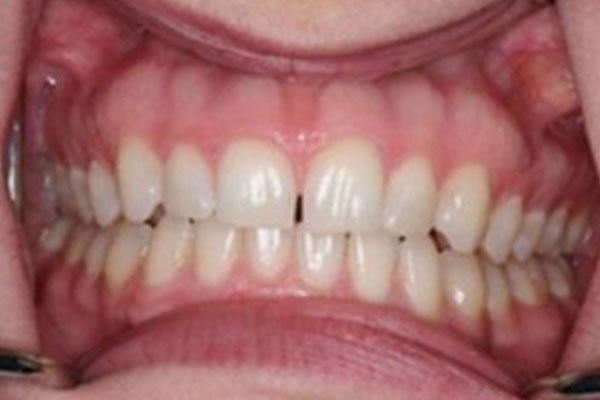 Teeth with gaps before porcelain veneers in Sharon.